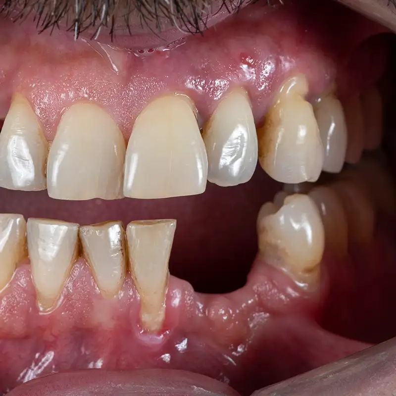 Dentadura con ausencia de diente